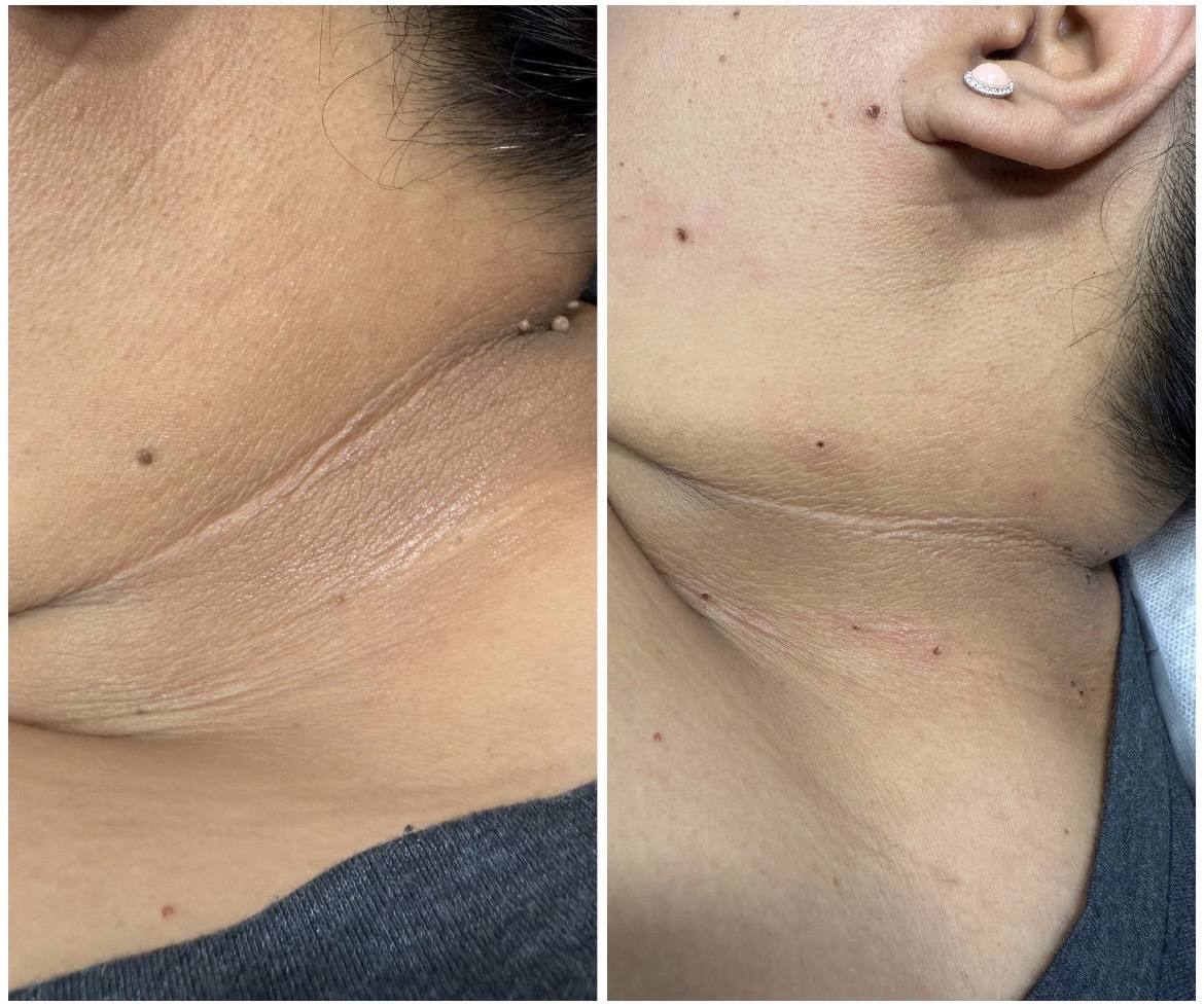 Facial before and after glowing skin Point Loma San Diego